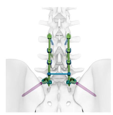 Система металофіксаторів TINA для фіксації хребта (Jinlu)